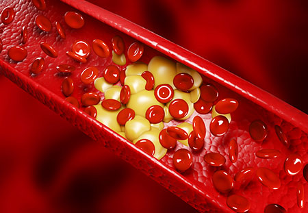 Doença Arterial Coronária