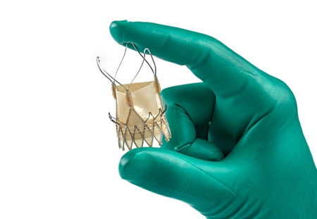 Substituição da válvula transcateter